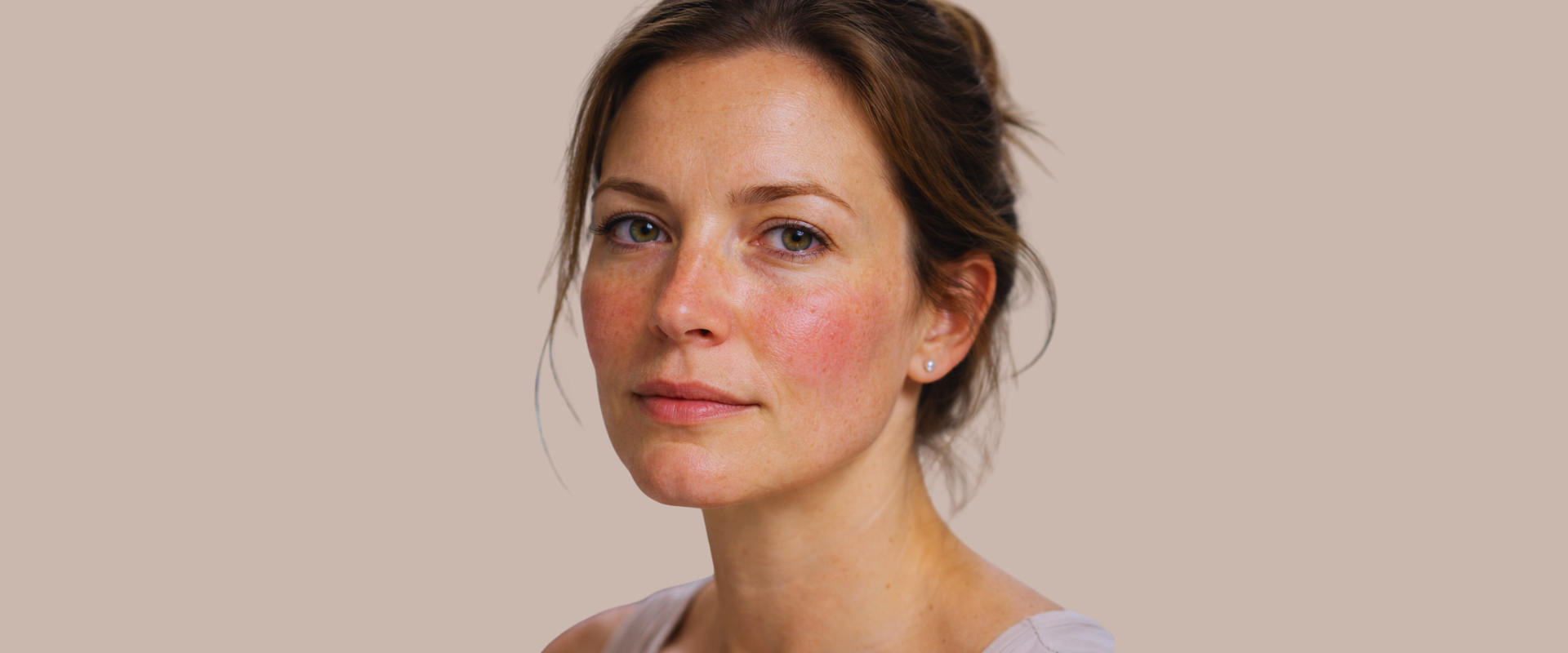 Tratamiento de rosácea - Dermatología
